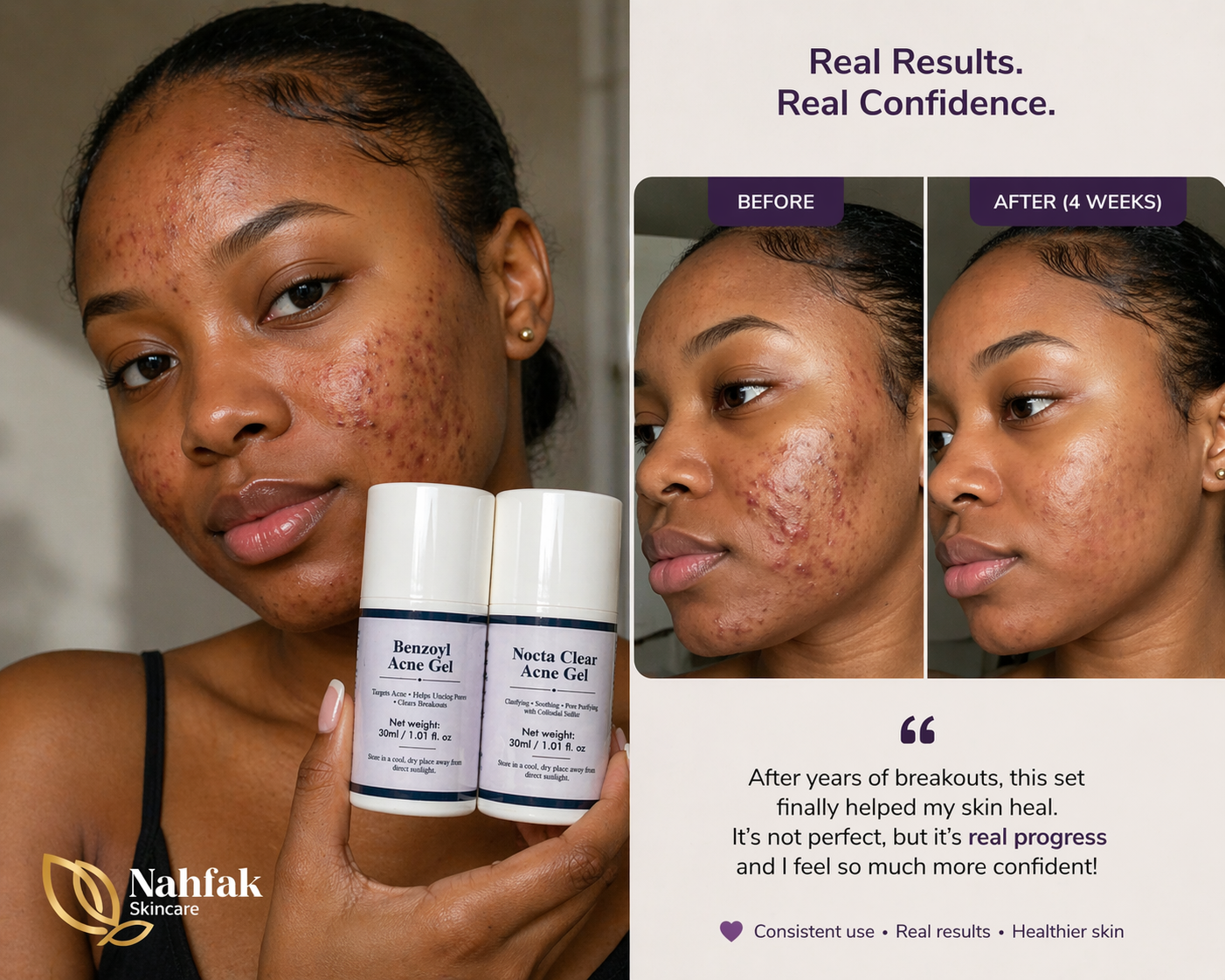 Acne Set